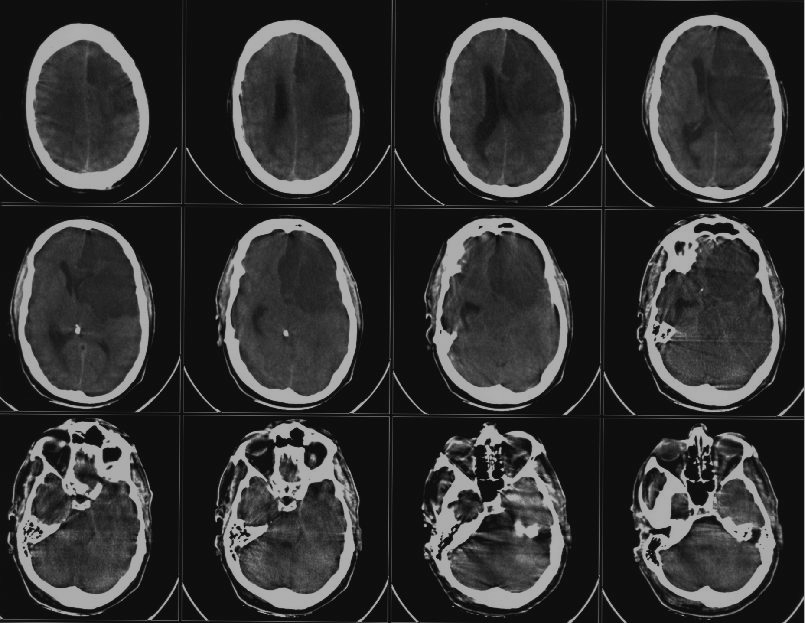 Серия КТ-снимков головного мозга после инсульта; фото: ru.wikipedia.org